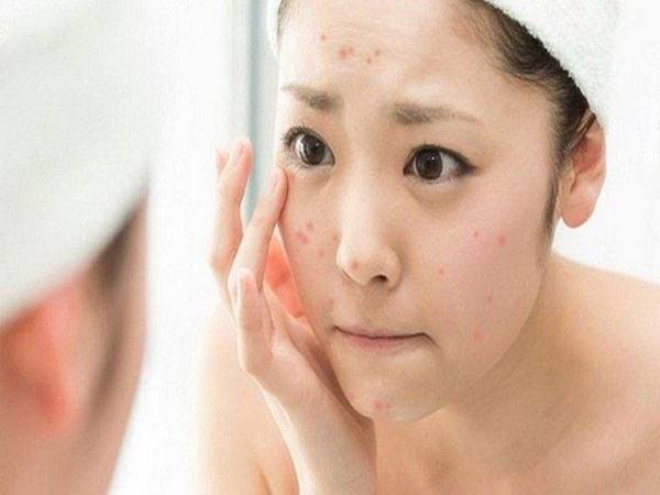 Nguyên nhân nào gây ra mụn trên da