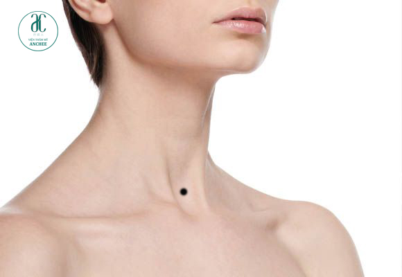Nốt ruồi ở cổ có lỗ tiền chôn?