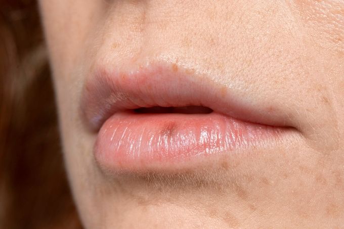  Kích thước và màu sắc của nốt ruồi son