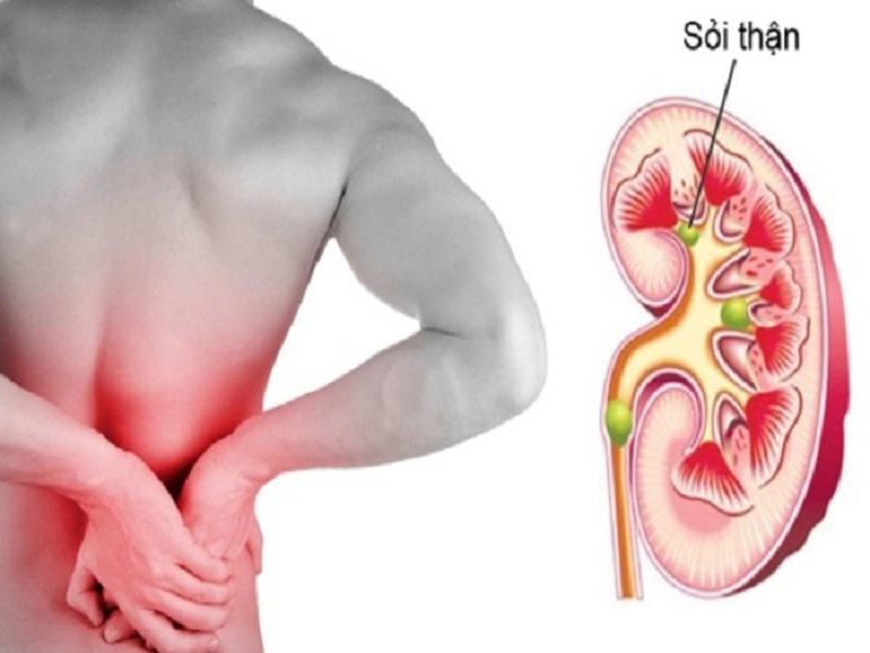 Sỏi thận là gì?